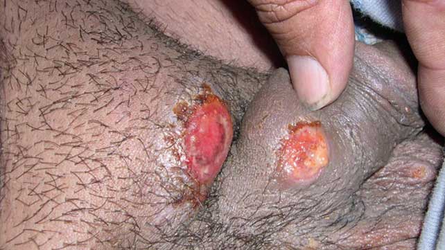 Illustration showing Prostate Infection and Sperm Damage in men